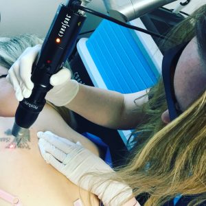 Julie Gessin usa un láser para quitar un tatuaje de la espalda de un paciente