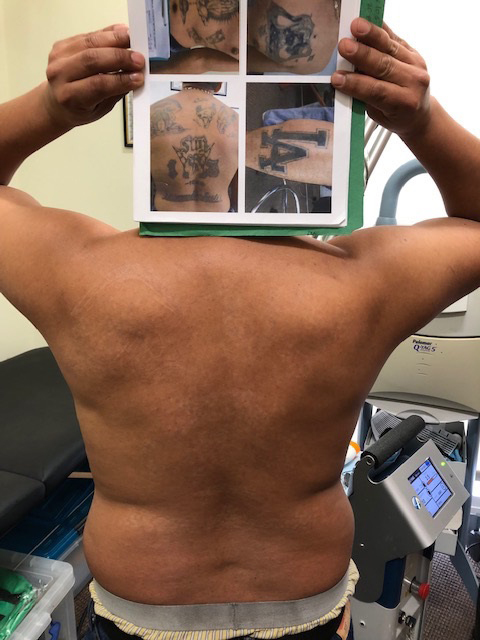 tattoo removal client holds old photos