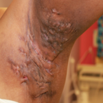 A person's skin with HS