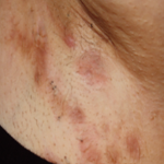 A person's skin with HS