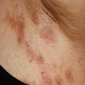 Hidradenitis Suppurativa, the Inflammatory Skin Disease with a Surprising Pathology - AAPA Hidradenitis Suppurativa, the Inflammatory Skin Disease with a Surprising Pathology - AAPA